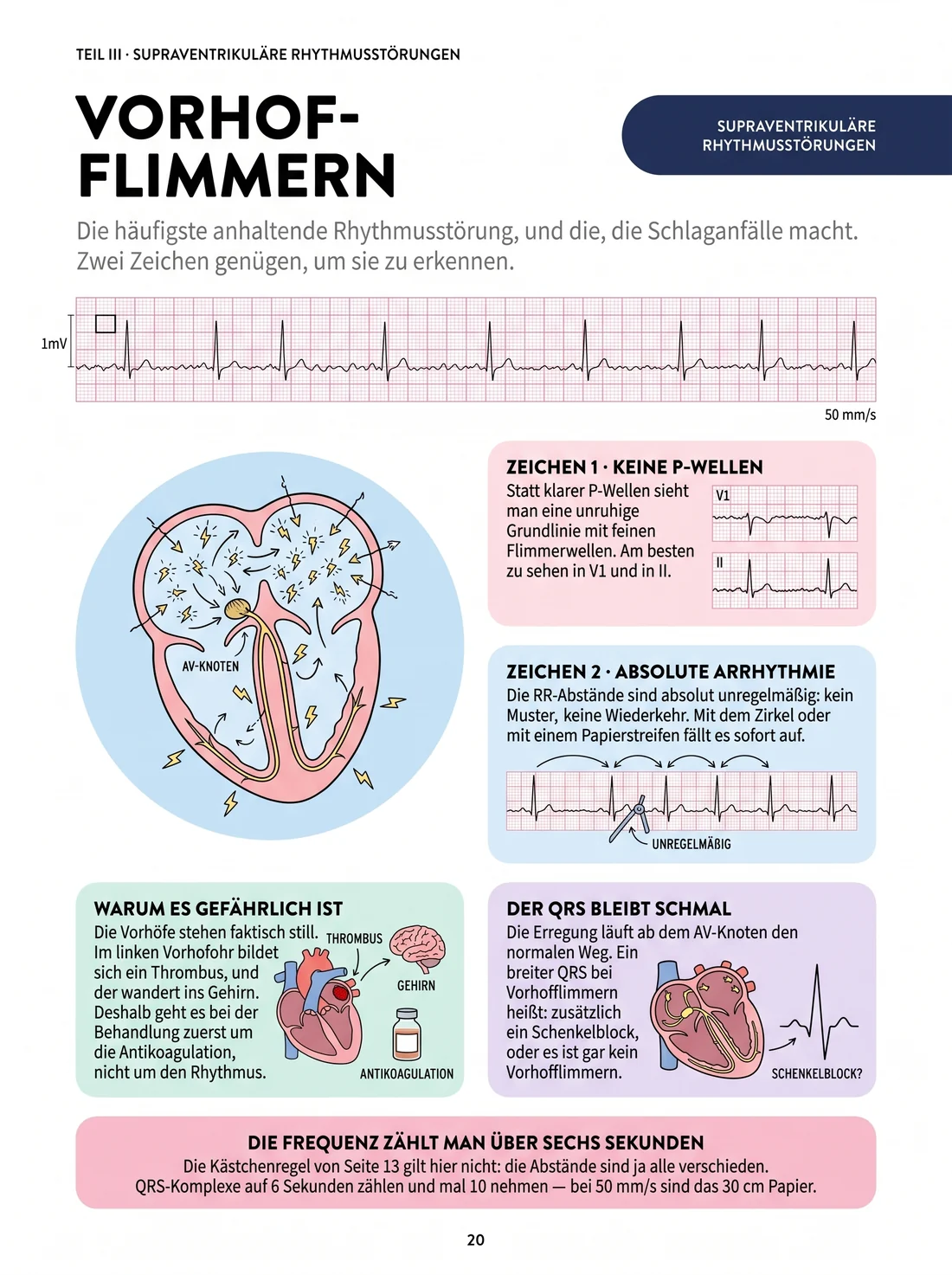 Vorhofflimmern