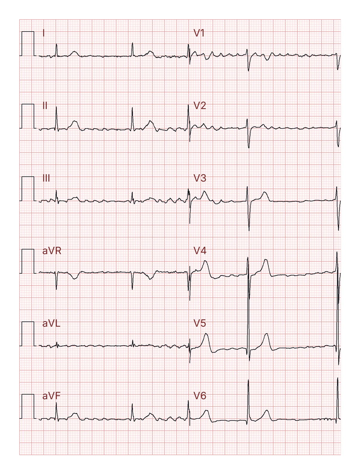 Un ECG a 12 derivazioni senza nessuna spiegazione